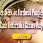 Face, Neck, or Forehead Pimples? Each Outbreak’s Causes Vary