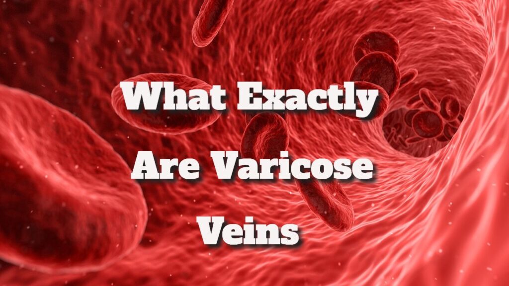 Veins Varicose What Exactly Are Varicose Veins